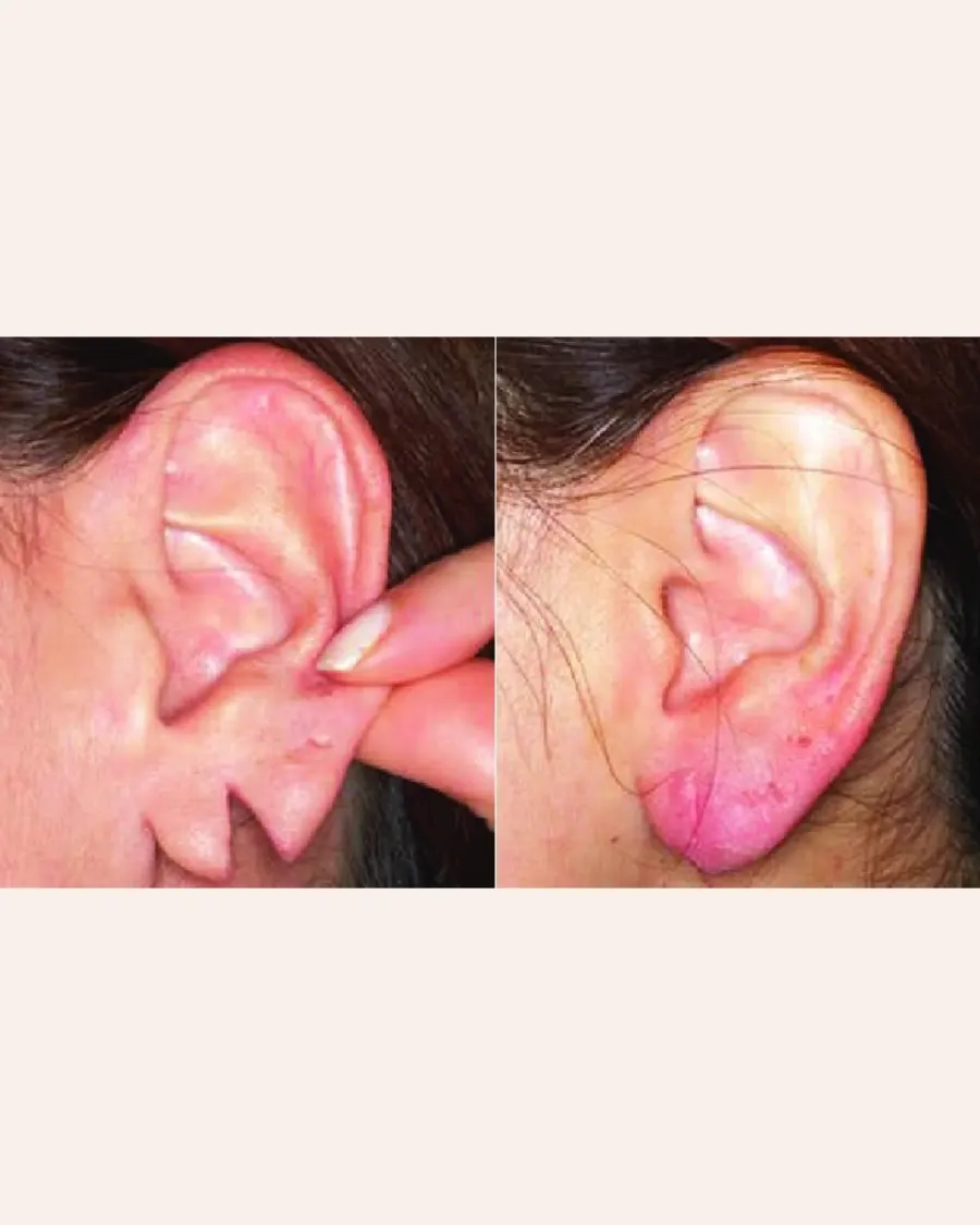 Ear lobe repair at Cinch Clinics